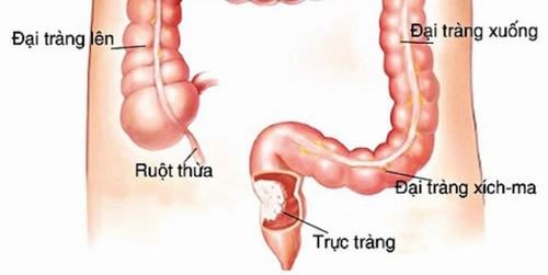 Viêm trực tràng đi ngoài ra máu