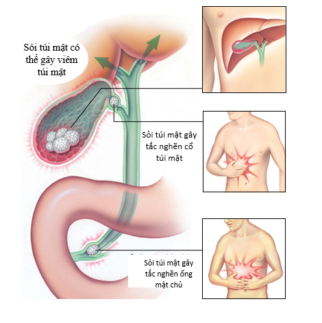 Viêm túi mật cấp và thời điểm phẫu thuật tốt nhất