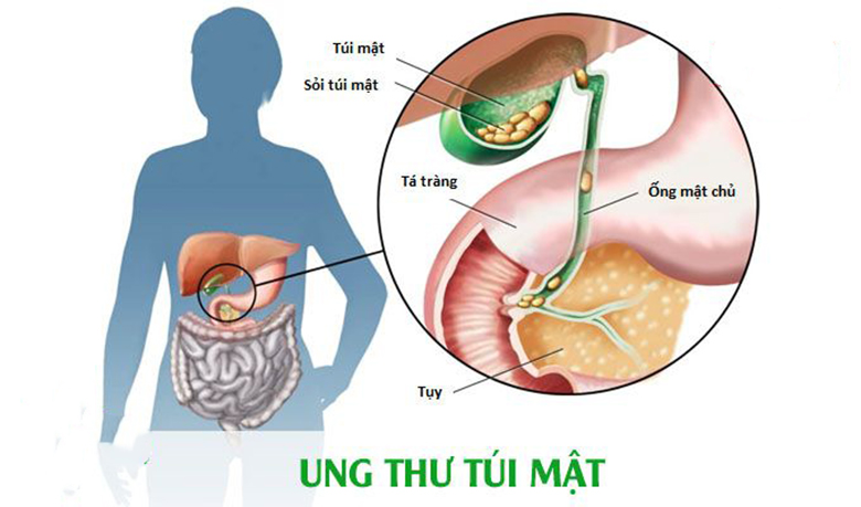 Viêm túi mật có nguy hiểm không? – Góc giải đáp