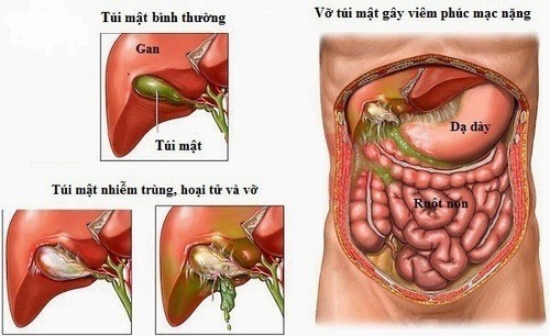 Viêm túi mật có nguy hiểm không? Làm sao để phát hiện sớm