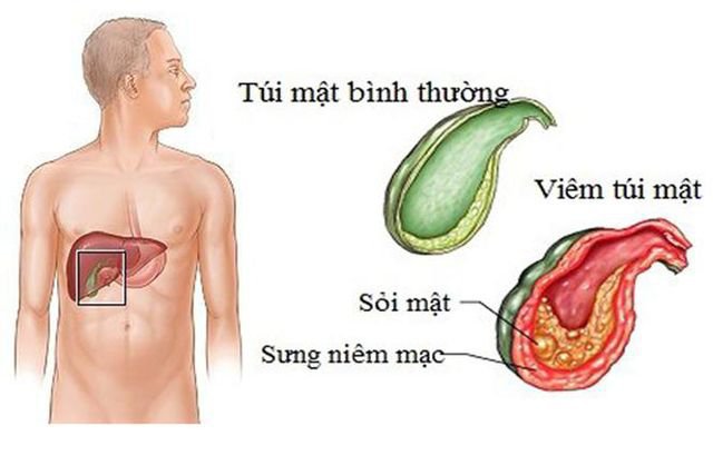 Viêm túi mật có phải mổ không – góc giải đáp