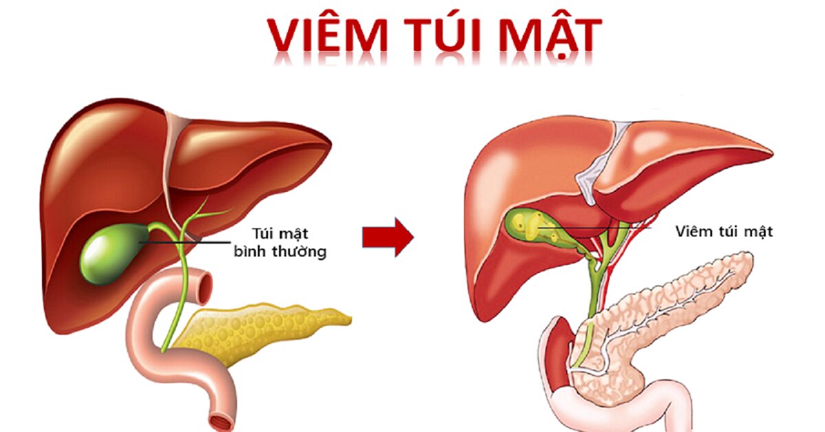 Viêm túi mật: Định nghĩa, nguyên nhân, triệu chứng và cách phòng bệnh 