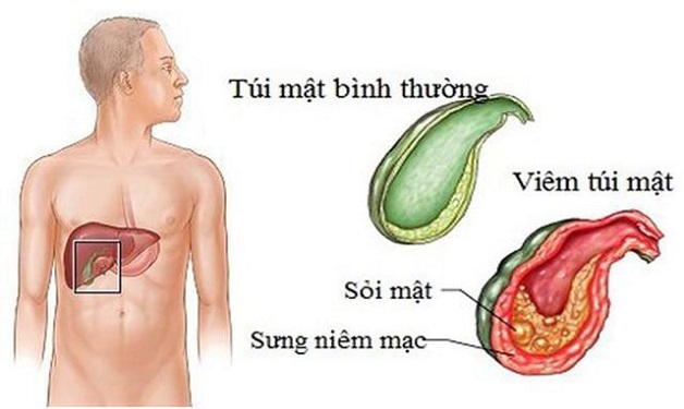 Viêm túi mật: Định nghĩa, nguyên nhân, triệu chứng và cách phòng bệnh 