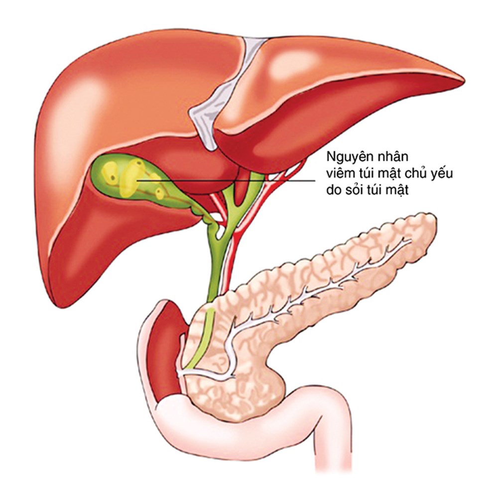 Viêm túi mật do sỏi và những điều cần biết