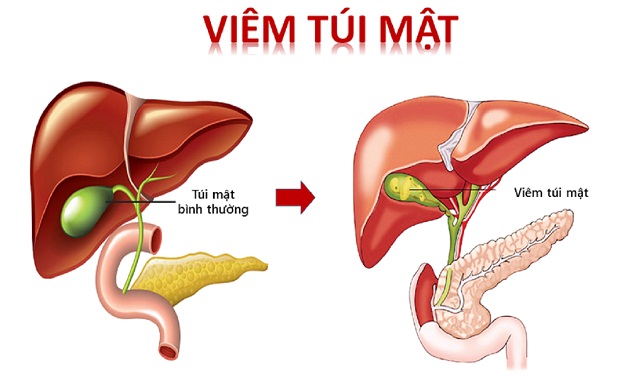 Viêm túi mật ở trẻ em: nguyên nhân, triệu chứng, điều trị