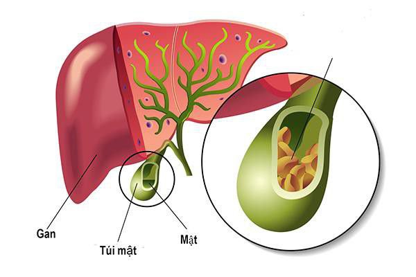 Viêm túi mật xơ teo và những điều cần biết