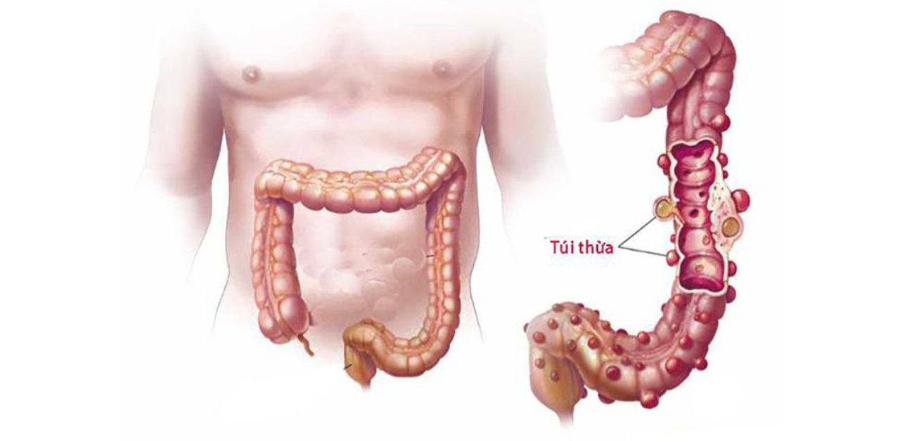 Viêm túi thừa cấp: Nguyên nhân, cách phòng ngừa