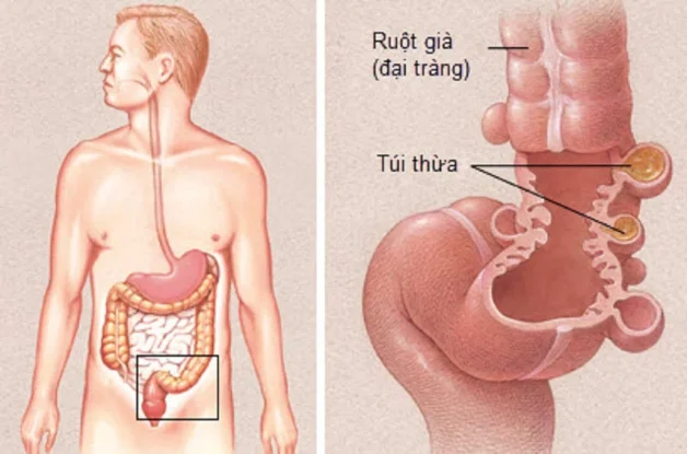 Viêm túi thừa cấp: Nguyên nhân, cách phòng ngừa