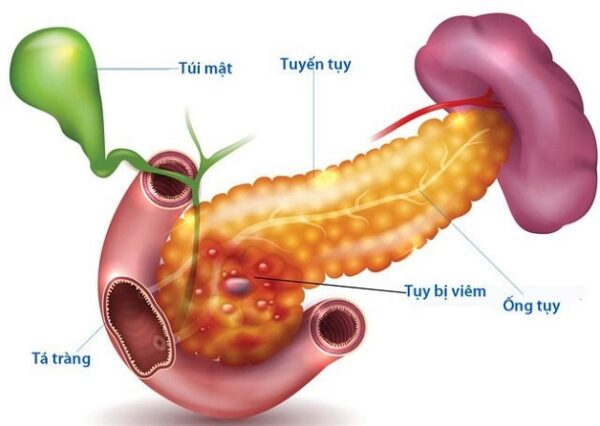 Viêm tụy cấp có dẫn tới tử vong?