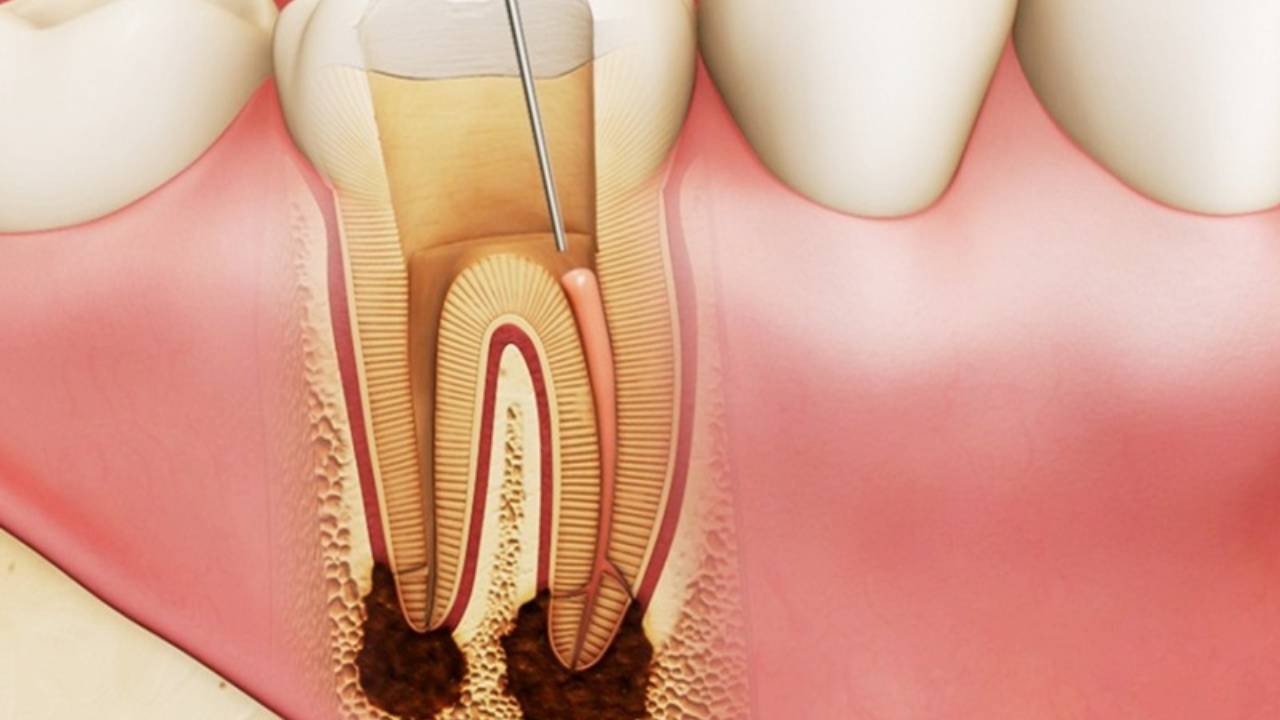 Viêm tủy chân răng – Nhận biết và điều trị đúng cách