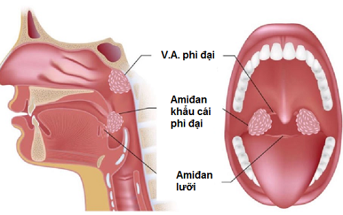 Viêm VA quá phát ảnh hưởng tới sức khỏe như thế nào?