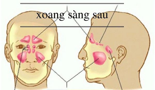 Viêm xoang sàng 2 bên: Dấu hiệu, nguyên nhân và cách điều trị