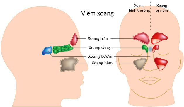 Viêm xoang sàng sau có nguy hiểm không?