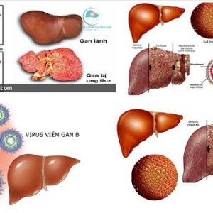 Việt Nam đứng thứ 3 thế giới về tỷ lệ mắc ung thư gan