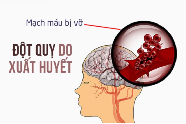 Vỡ mạch máu não: Triệu chứng, nguyên nhân và cách xử trí