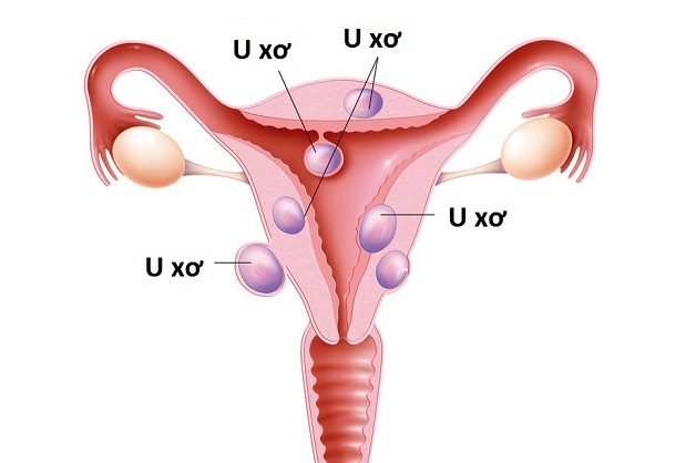 Vỡ u xơ tử cung: Nguyên nhân, biến chứng và biện pháp xử trí