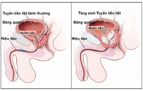 Vôi hóa tuyến tiền liệt nguyên nhân do đâu?