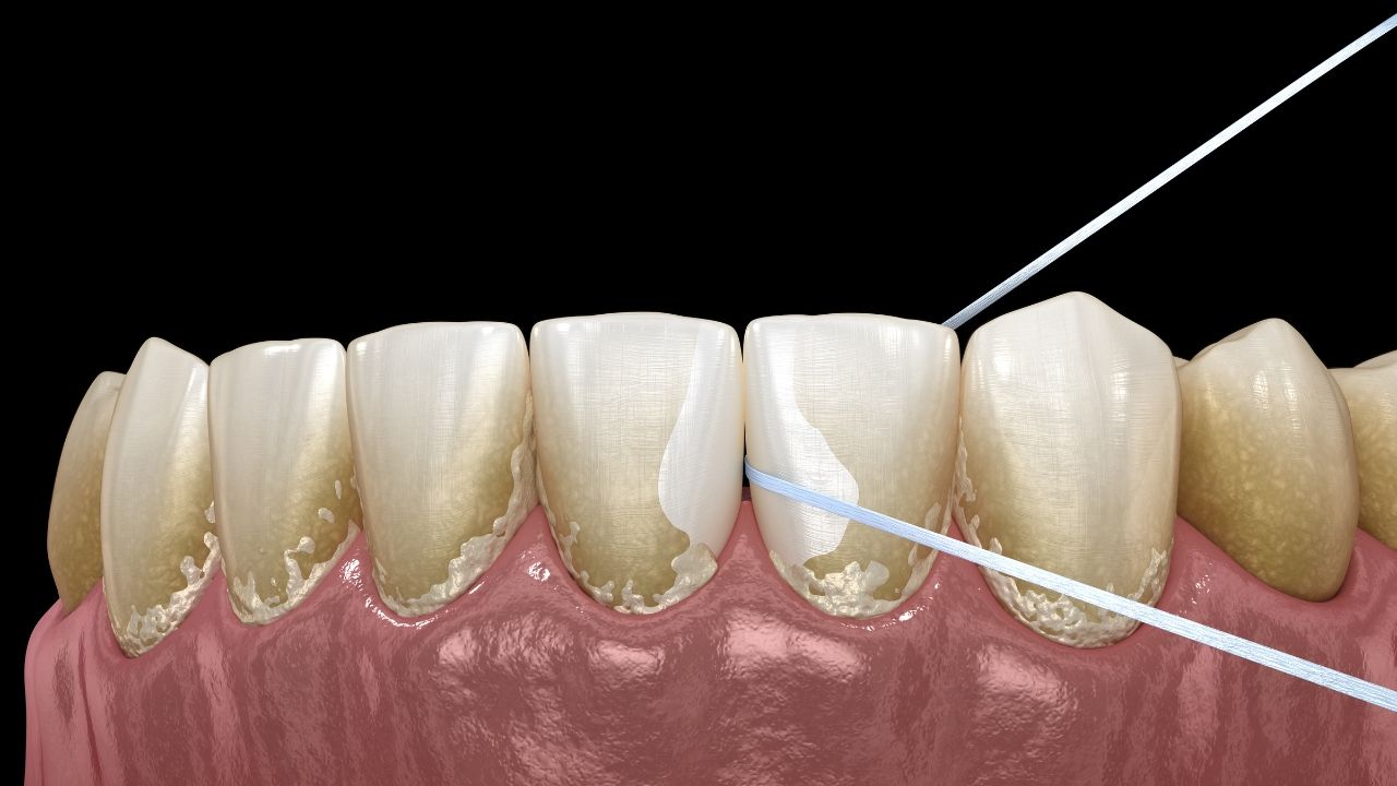 Vôi răng: Quá trình xử lý và hướng dẫn hạn chế sự hình thành