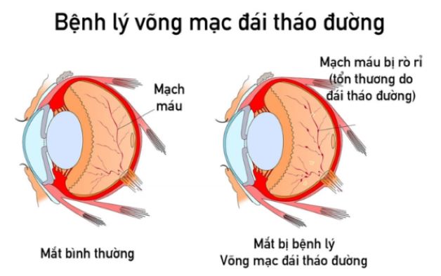 Võng mạc mỏng nhất ở đâu và cách bảo vệ võng mạc mắt