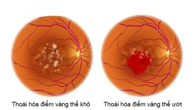 Võng mạc thoái hóa, căn bệnh nguy hiểm đối với mắt