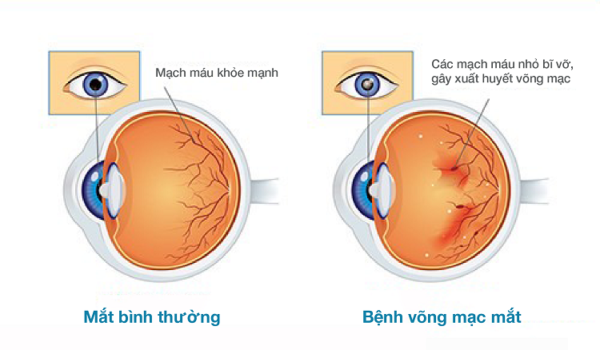 Võng mạc tiểu đường là gì? Nguyên nhân và cách chữa