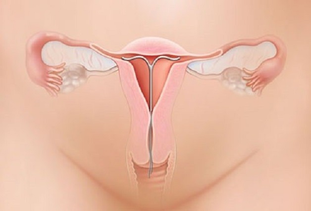 Vòng tránh thai iud và những điều bạn cần biết