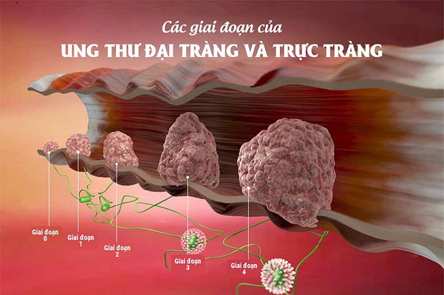 Xạ trị ung thư đại trực tràng bao nhiêu tiền?