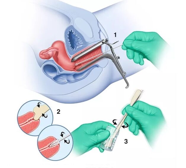 Xét nghiệm chẩn đoán xác định ung thư cổ tử cung