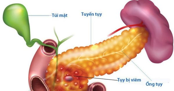 Xét nghiệm men tụy có giá trị như thế nào trong viêm tụy cấp 