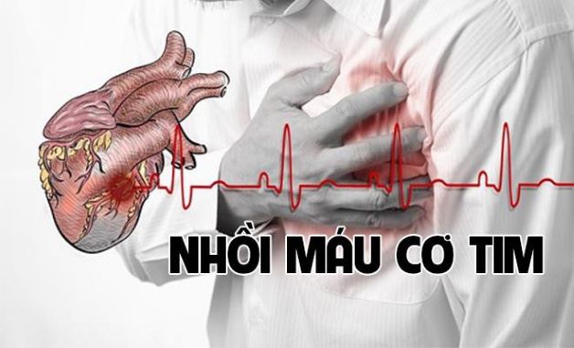 Xét nghiệm nhồi máu cơ tim gồm những gì, khi nào cần làm?