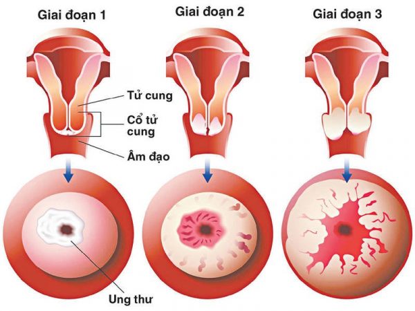 Xét nghiệm tầm soát ung thư cổ tử cung nào đang phổ biến?