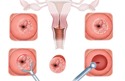 Xét nghiệm tế bào ung thư cổ tử cung là gì?