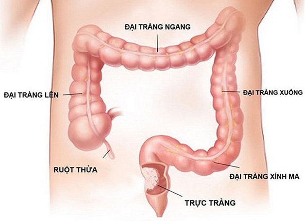 Xét nghiệm ung thư đại tràng bằng cách nào?