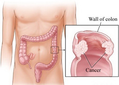 Xét nghiệm ung thư đại tràng chẩn đoán sớm bệnh
