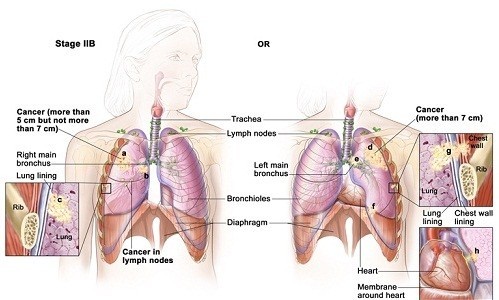 Xét nghiệm ung thư phổi