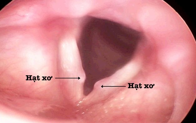 Xơ dây thanh quản điều trị bằng cách nào hiệu quả?