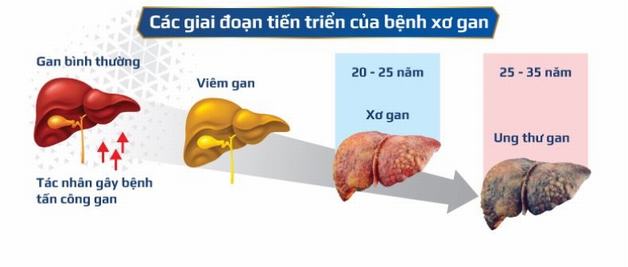 Xơ gan bệnh học: Những điều cần biết về bệnh xơ gan