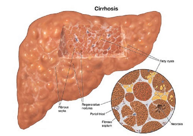 Xơ gan bệnh học: Những điều cần biết về bệnh xơ gan