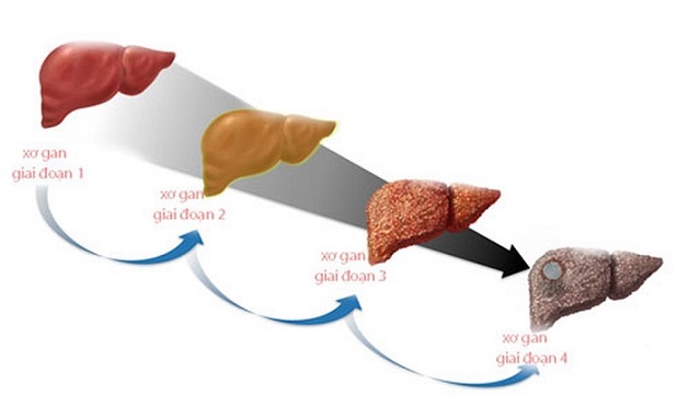 Xơ gan cấp độ 2 là gì? Có chữa được không? 