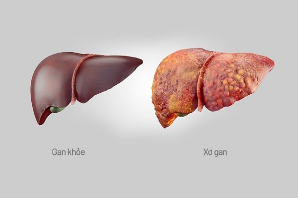 Xơ gan có lây không và những điều cần biết