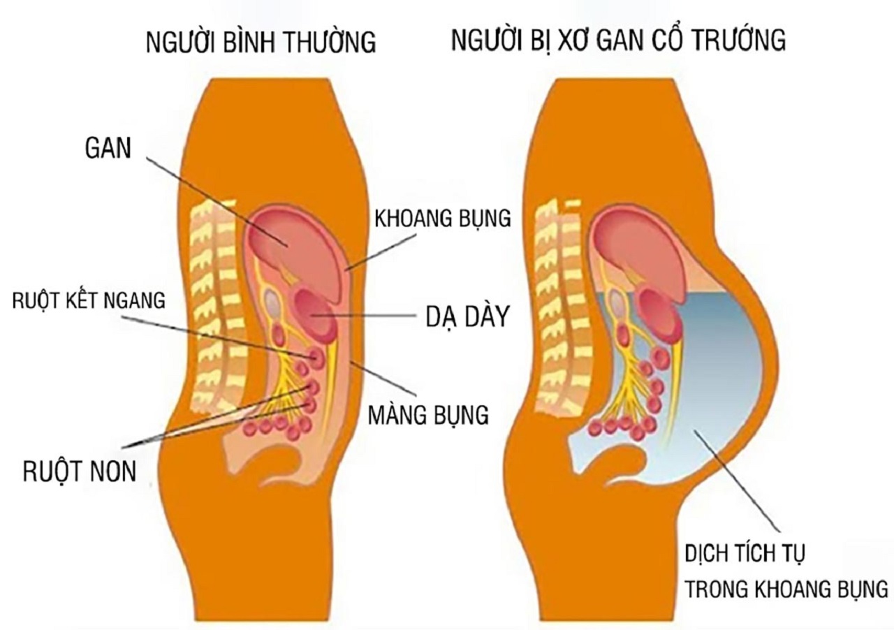 Xơ gan cổ trướng chẩn đoán dựa vào đâu?