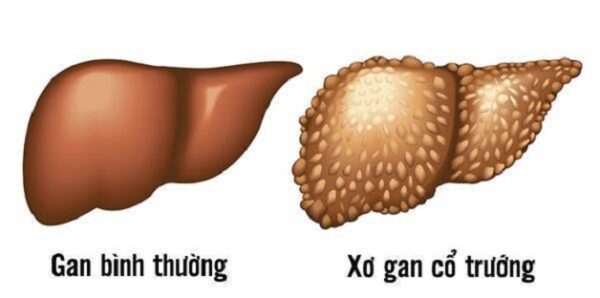 Xơ gan cổ trướng chẩn đoán dựa vào đâu?