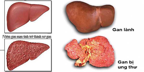 Xơ gan cổ trướng có chữa được không?