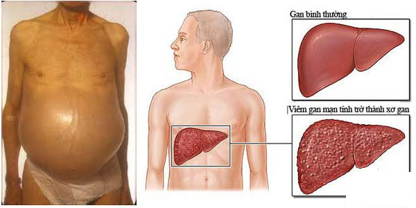 Xơ gan cổ trướng có chữa được không?