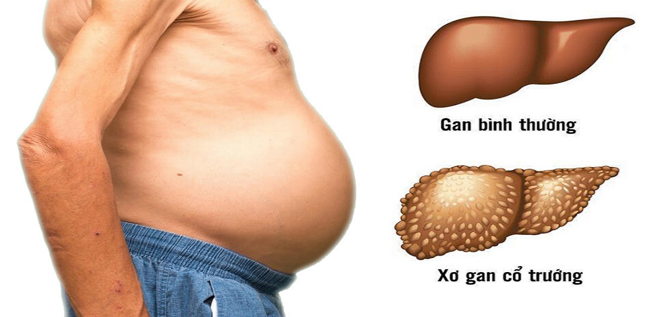 Xơ gan cổ trướng là gì? Cách nhận biết và điều trị