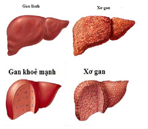 Xơ gan cổ trướng là gì? Cách nhận biết và điều trị