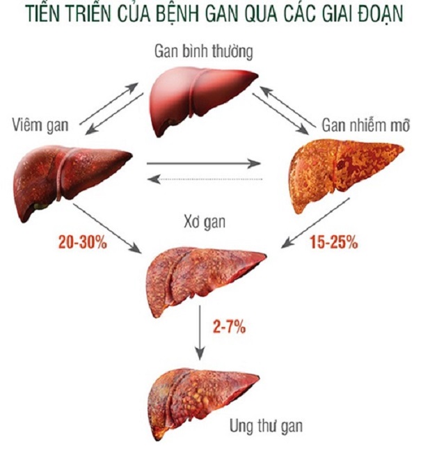 Xơ gan cổ trướng: Nguyên nhân và cách điều trị