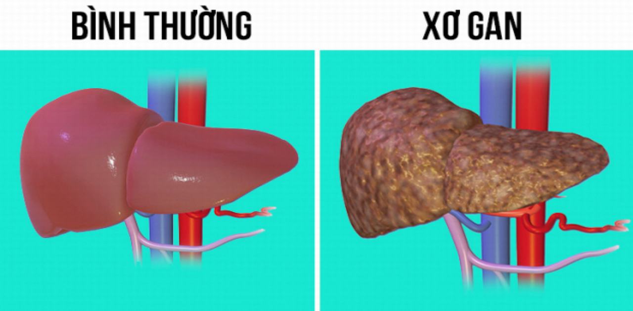 Xơ gan độ 3 sống được bao lâu? Giải đáp từ chuyên gia