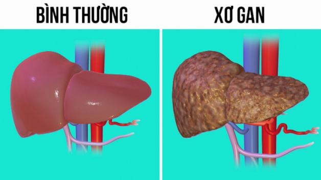 Xơ gan độ 3 sống được bao lâu? Giải đáp từ chuyên gia