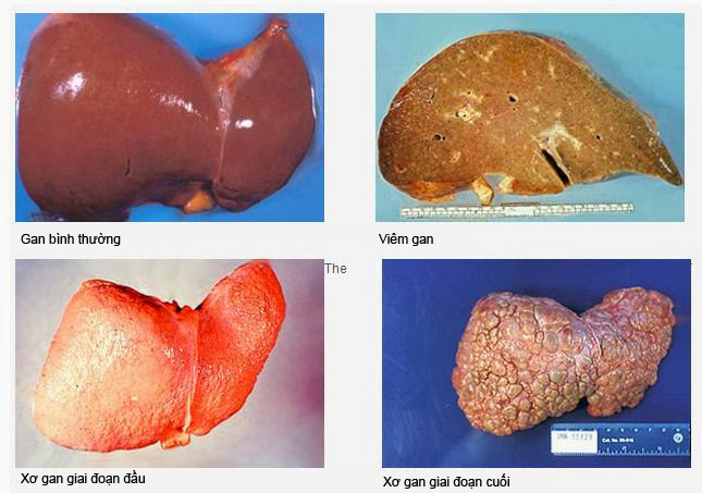 Xơ gan F4 là gì? Nguyên nhân và triệu chứng của bệnh